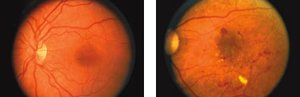 Two images of a human retina, one with healthy blood vessels and the other showing signs of diabetic retinopathy