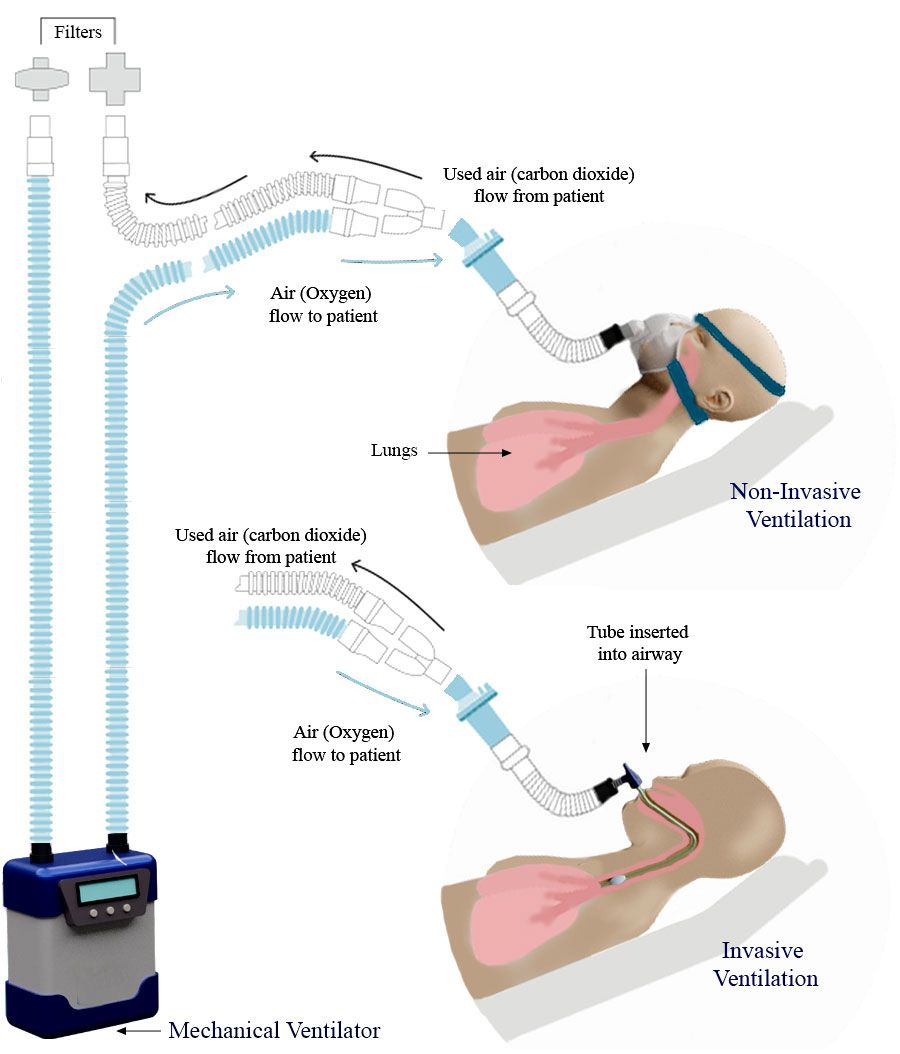 Illustration of non-invasive, and invasive methods of ventilation.