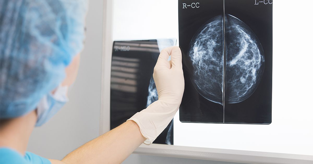 Computers Match Accuracy of Radiologists in Screening for Breast Cancer Risk