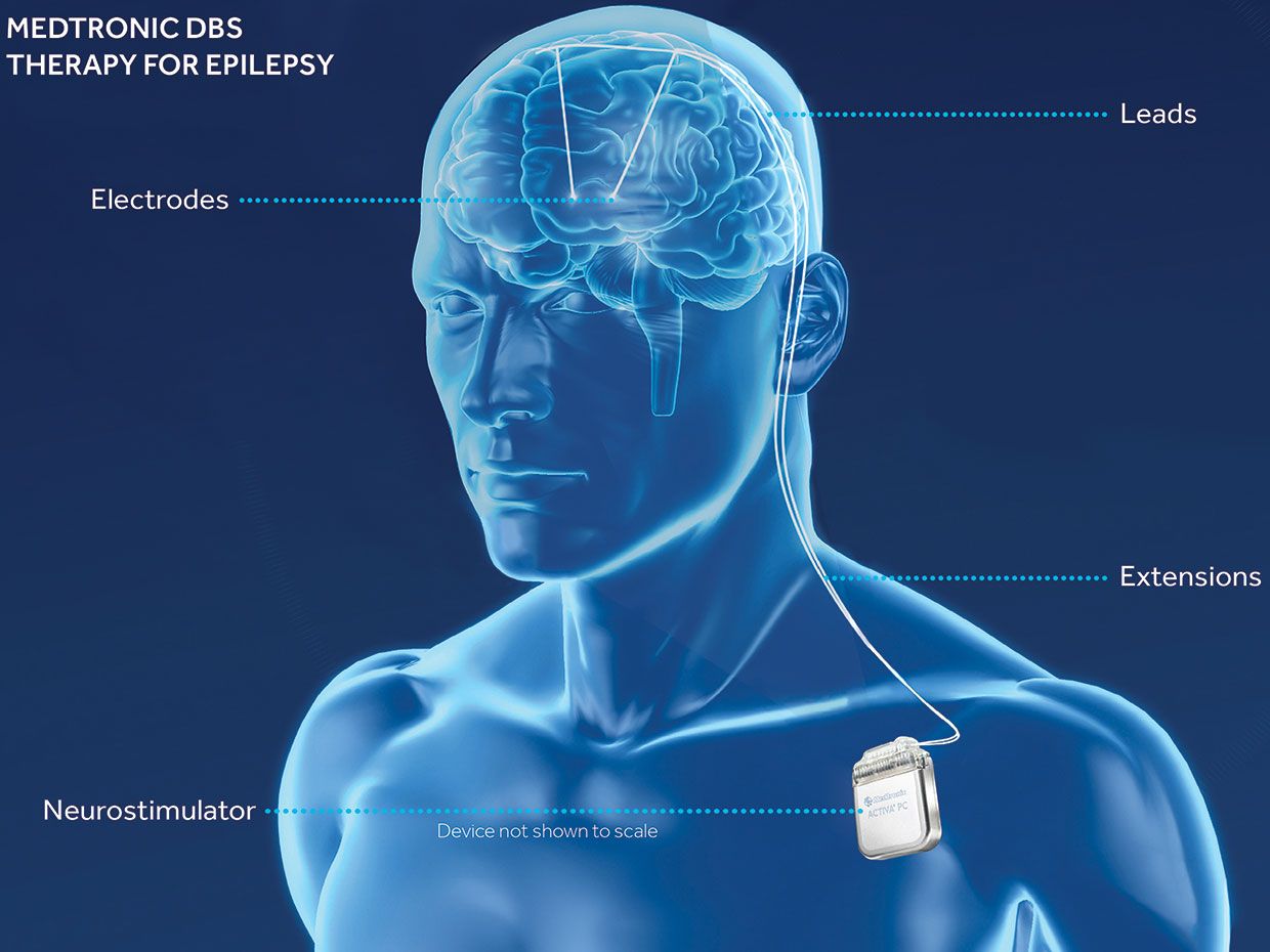 Medtronic diagram illustration of DBS therapy for epilepsy