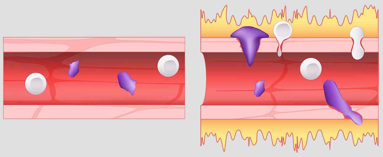 A normal blood vessel, shown at left, is compared with a blood vessel affected by excess bradykinin. A hyperactive bradykinin system permits fluid, shown in yellow, to leak out and allows immune cells, shown in purple, to squeeze their way out of blood vessels. 