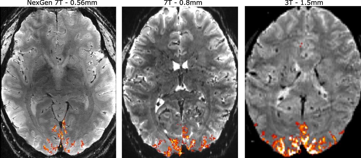 3 black and white images of the brain with small sections of red at the bottom 