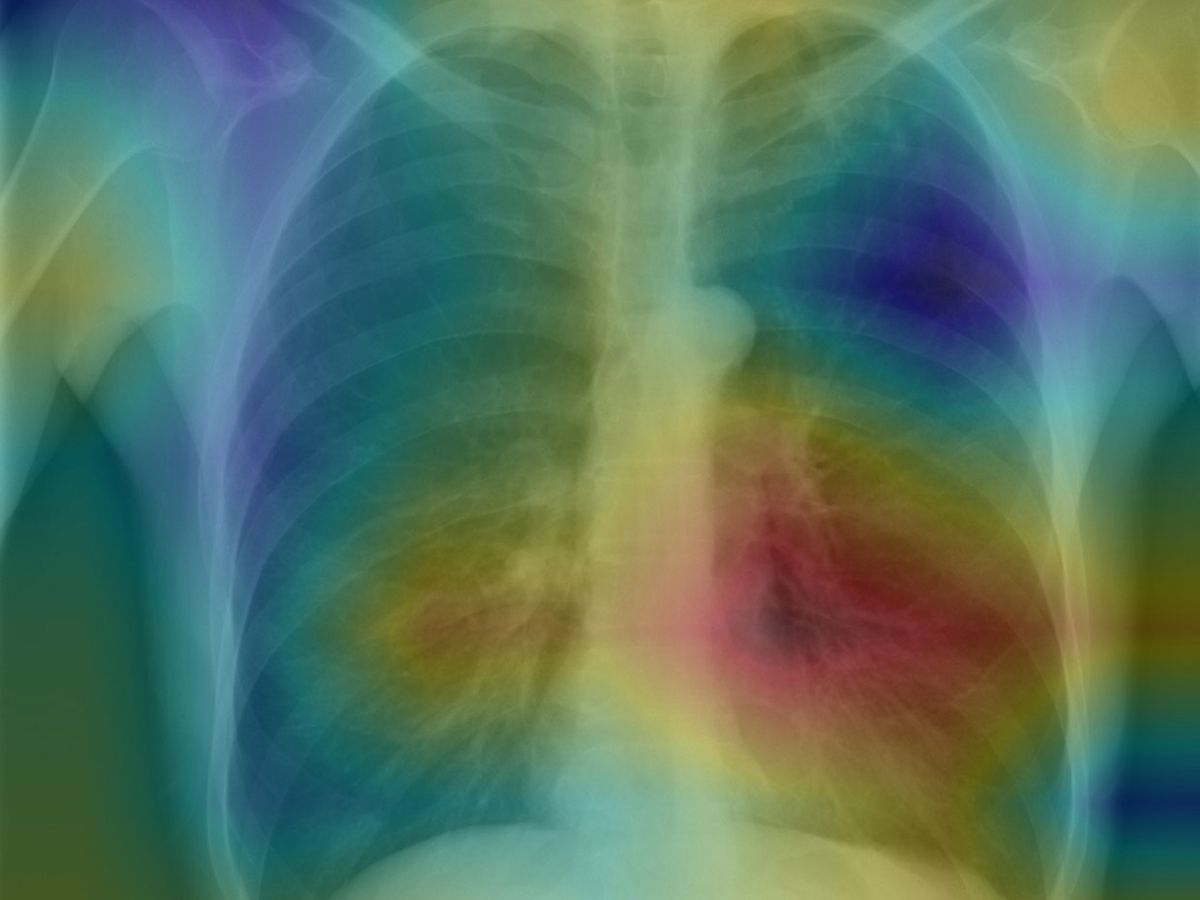 A chest x-ray colorized by a Stanford algorithm to highlight possible areas of pneumonia