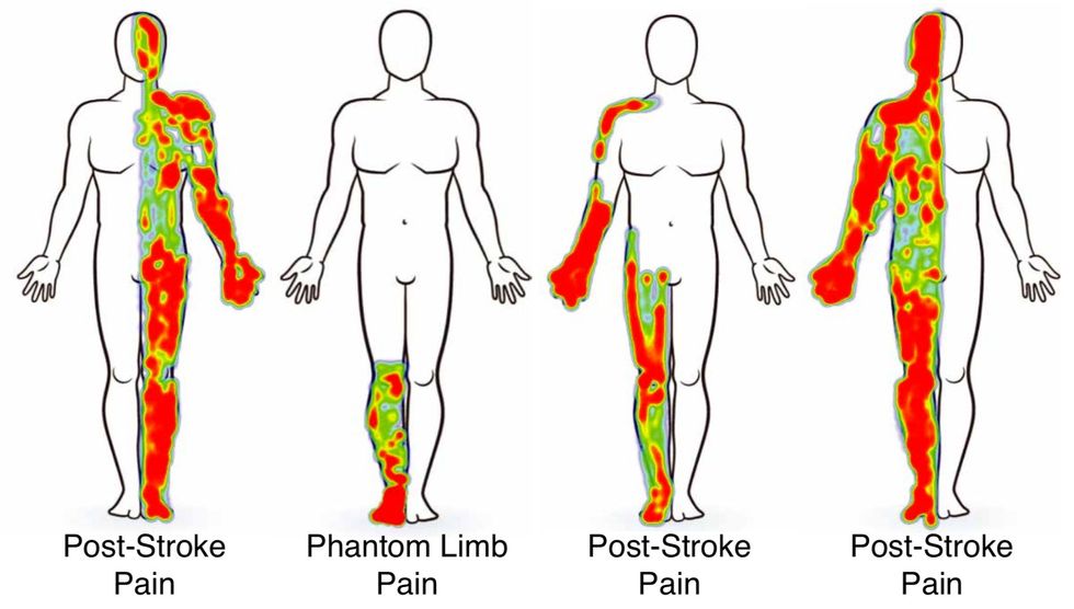 A diagram of four outlines of human bodies, with different portions highlighted. From left to right, the areas highlighted are: The entire right half, the lower left leg, the left leg and left arm, and the entire left half.