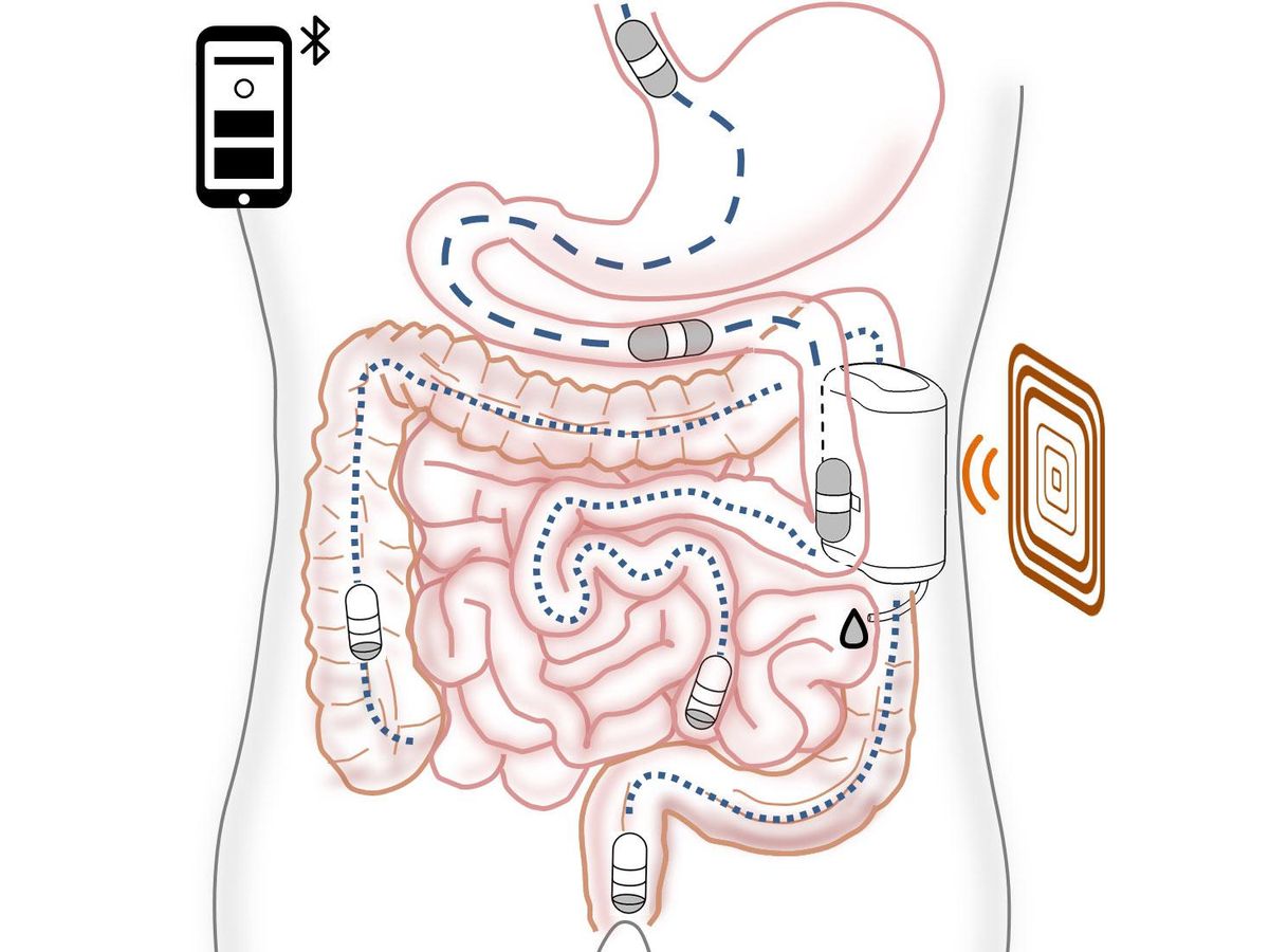 A diagram shows the concept of a robotic insulin delivery system that would be implanted in the gut. 
