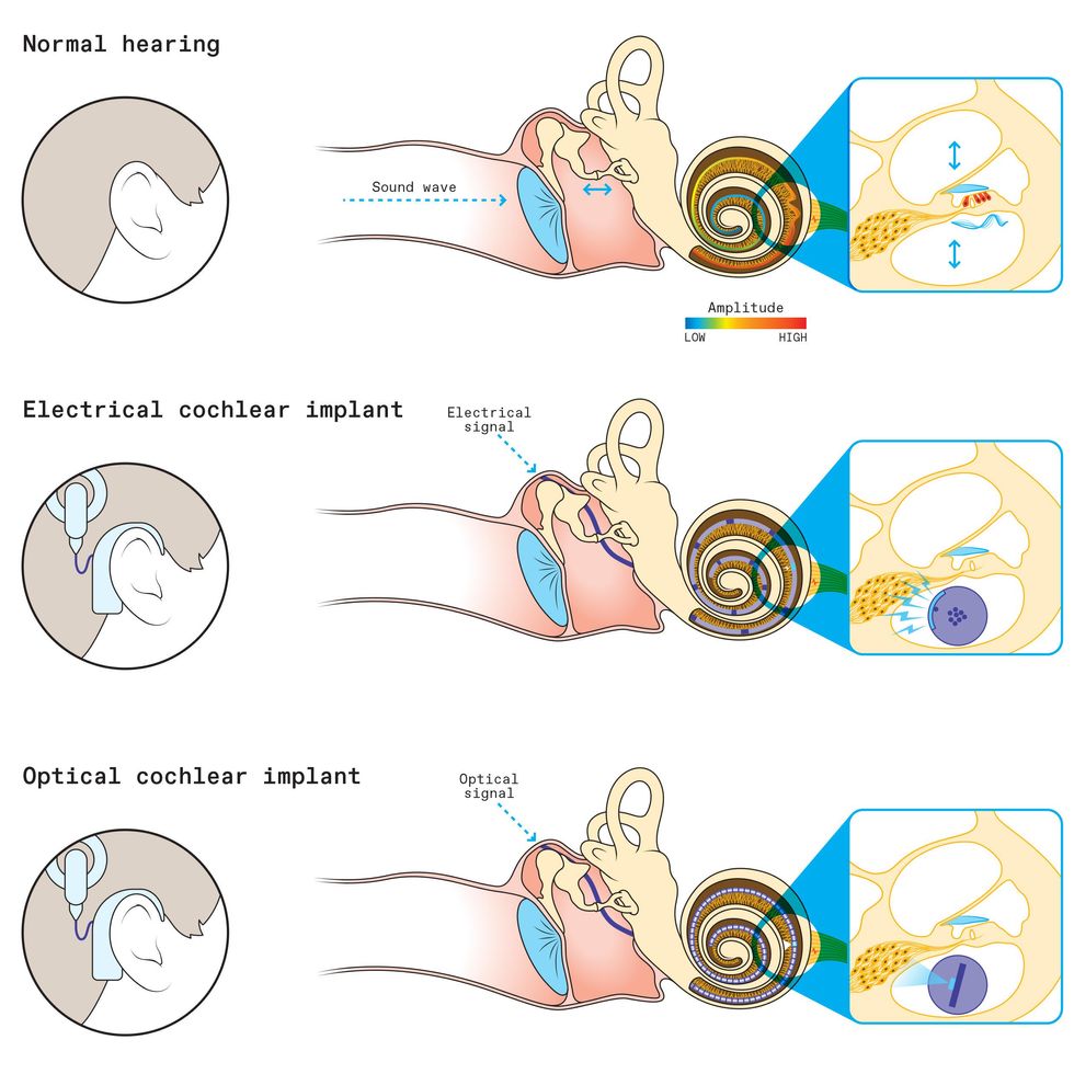 A diagram with three parts shows the differences between normal hearing, electrical cochlear implant, and optical cochlear implant. Each shows the anatomy of the middle and inner ear, including the spiral shaped cochlea.