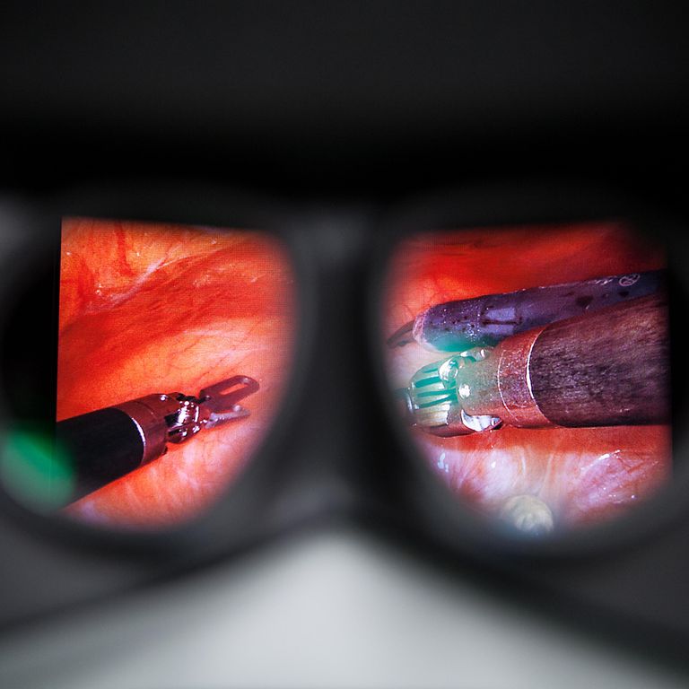 A photo shows the field of view that the surgeon sees, with magnified tools working on magnified flesh.