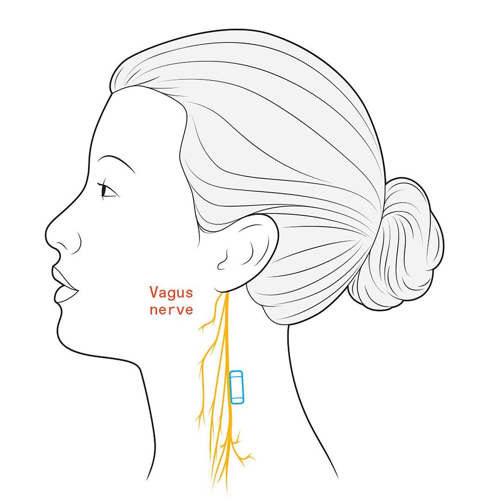An illustrated profile of a woman showing a branching nerve in her neck and a blue rectangle beside it.