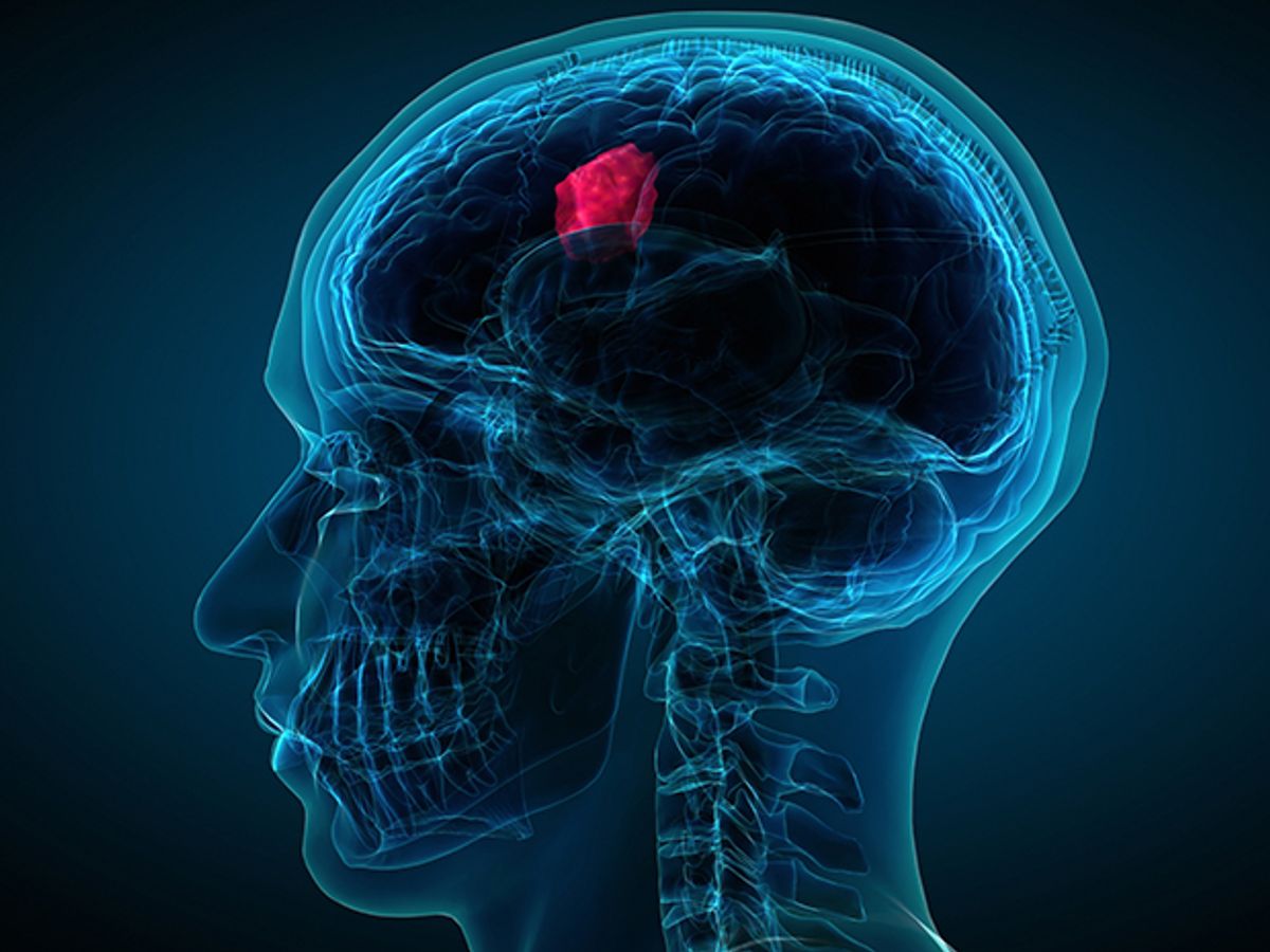 An illustration shows a transparent human head in profile with a brain tumor highlighted in red.