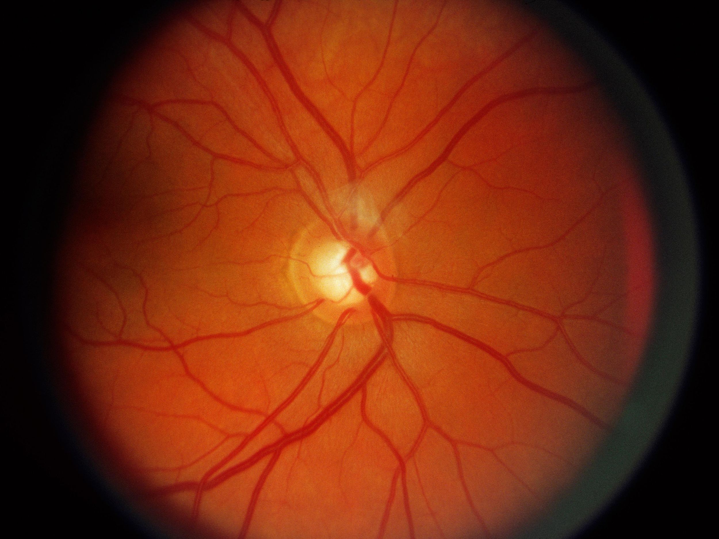 close up photo of retina in eye with glaucoma