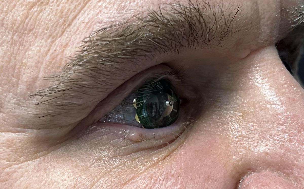 closeup of eye with contact lens containing electronic components