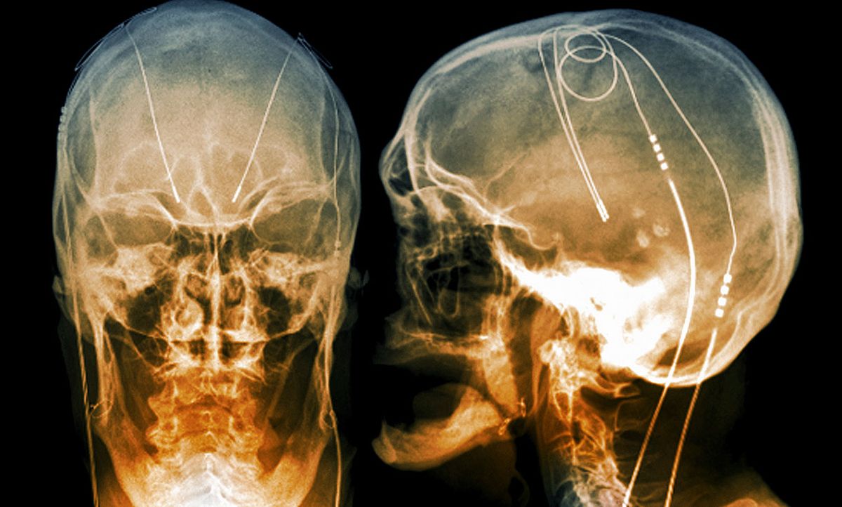 Coloured X-rays of sections through the head of a 61-year-old patient with Parkinson's disease (PD), showing the electrodes (light lines) of a deep brain stimulator (DBS) implanted in the brain.