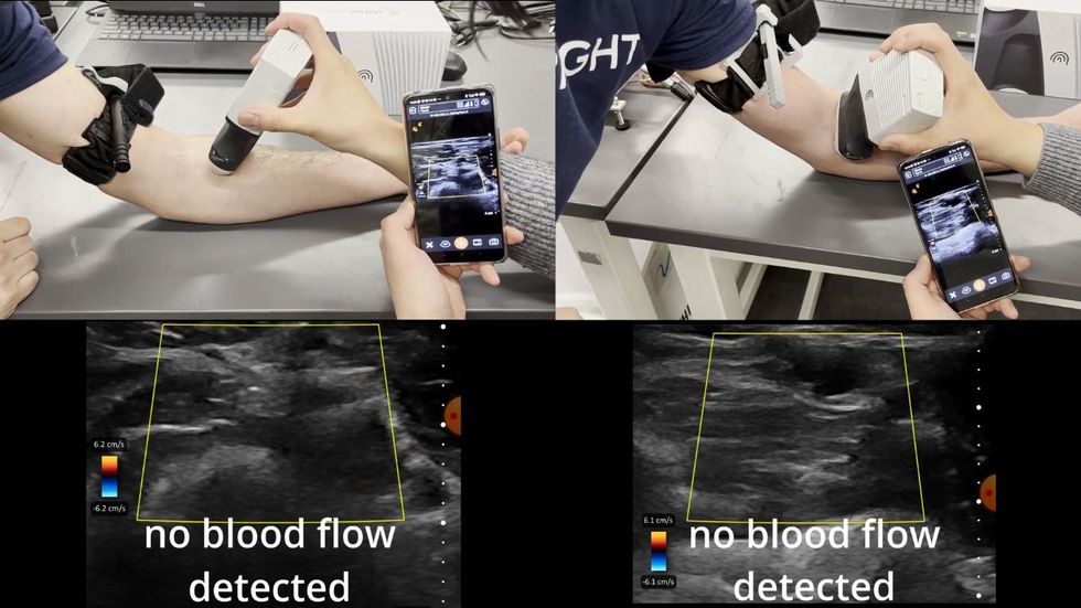 Comparison photos of tourniquets on arms and technology checking blood flow.