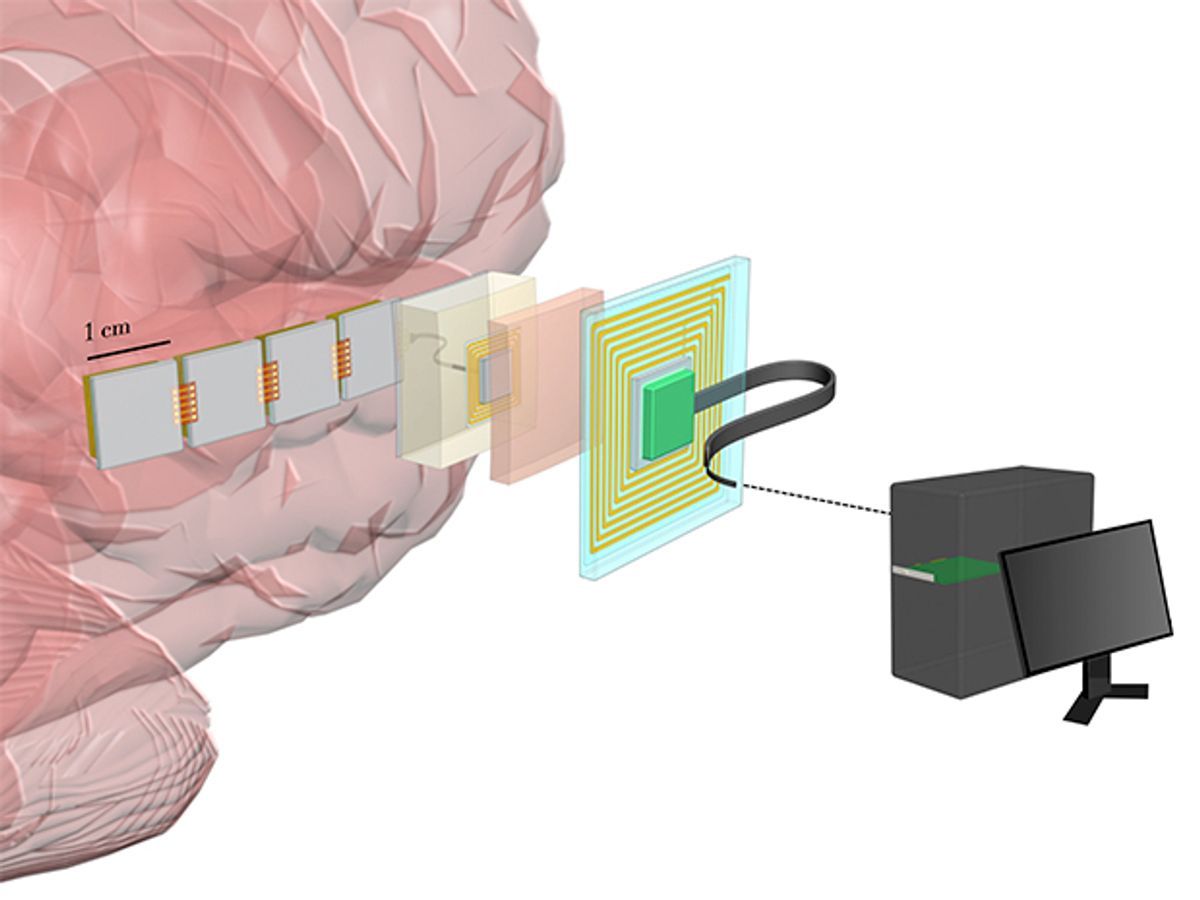 Diagram shows a brain with implanted chips that send a wireless signal to an electronic patch on the scalp, which is wired to a computer.