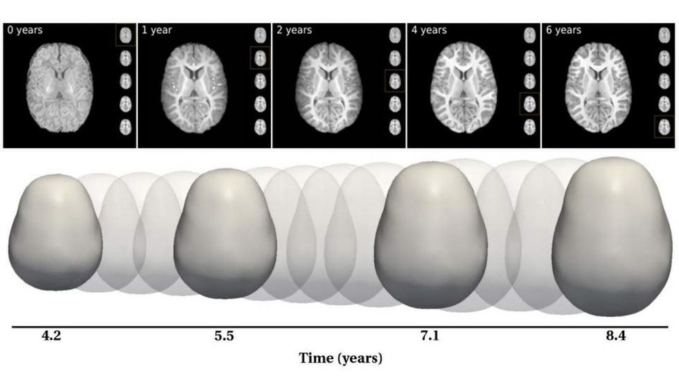Five MRI images of an infant brain.