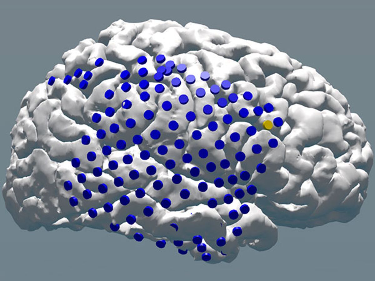 illustration of a brain studded with purple electrodes