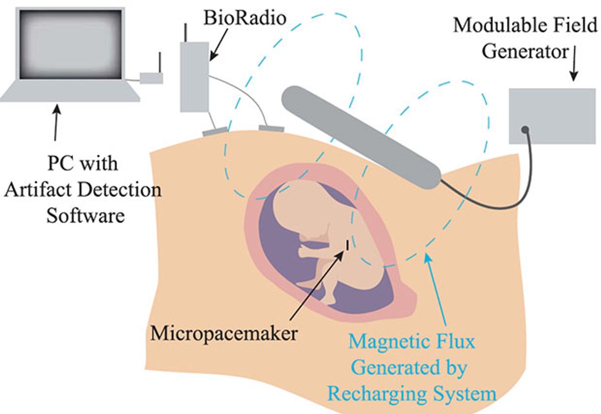 Illustration of a fetal micropacemaker