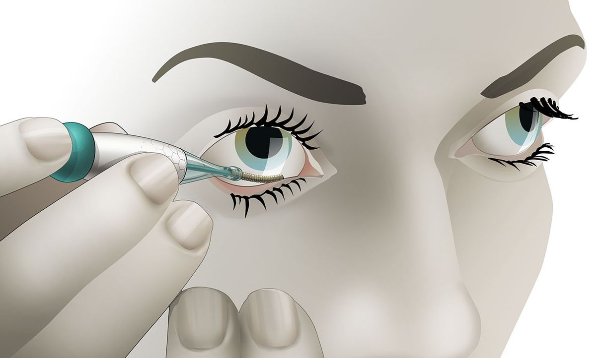 Illustration of a patient inserting the Noviosense tear glucose sensor behind the lower eyelid.