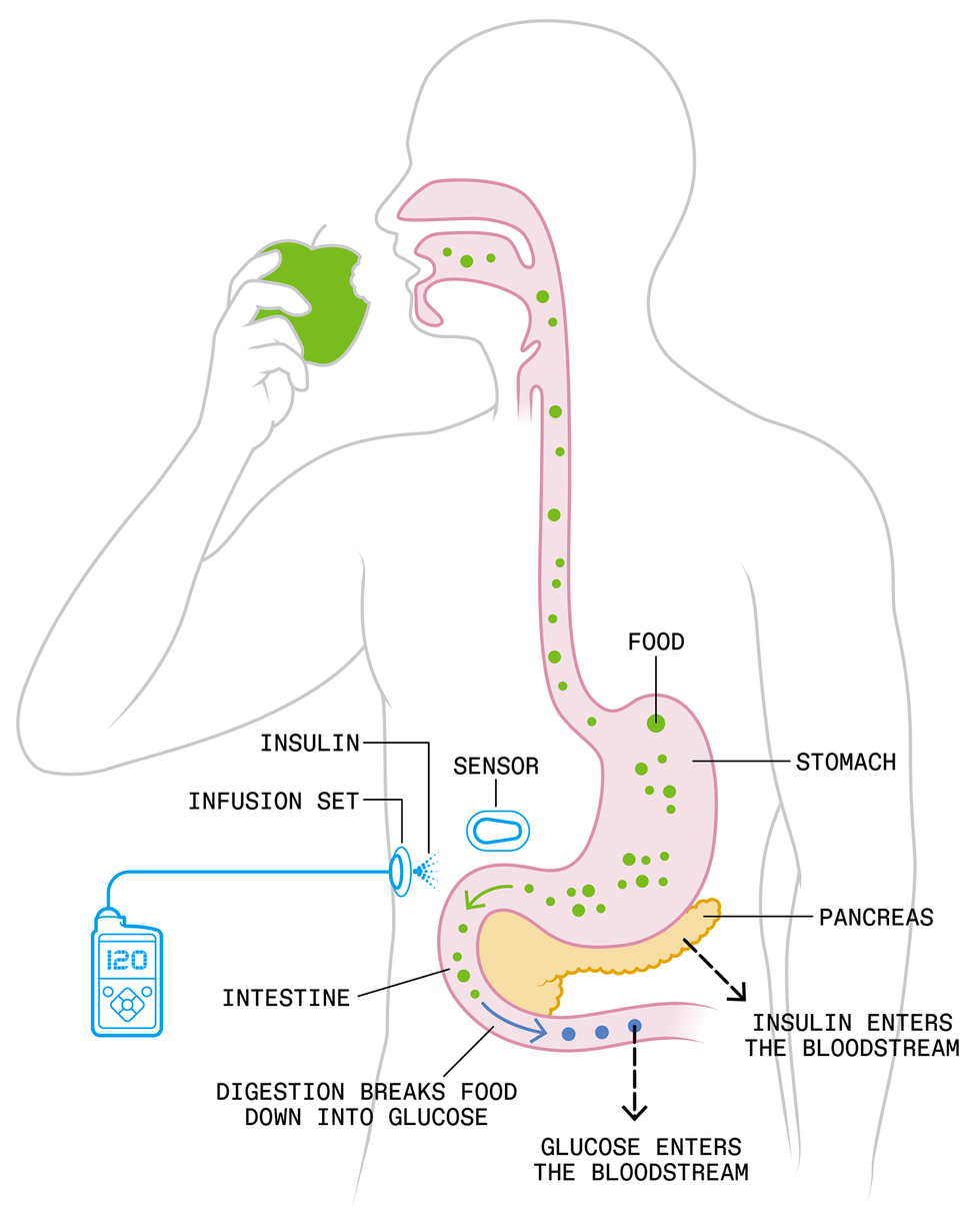 Illustration of a person eating a green apple. The digestive system is highlighted to show food being digested, and broken down into glucose. In blue, an infusion set and external insulin pump are shown to be pumping Insulin into the body.