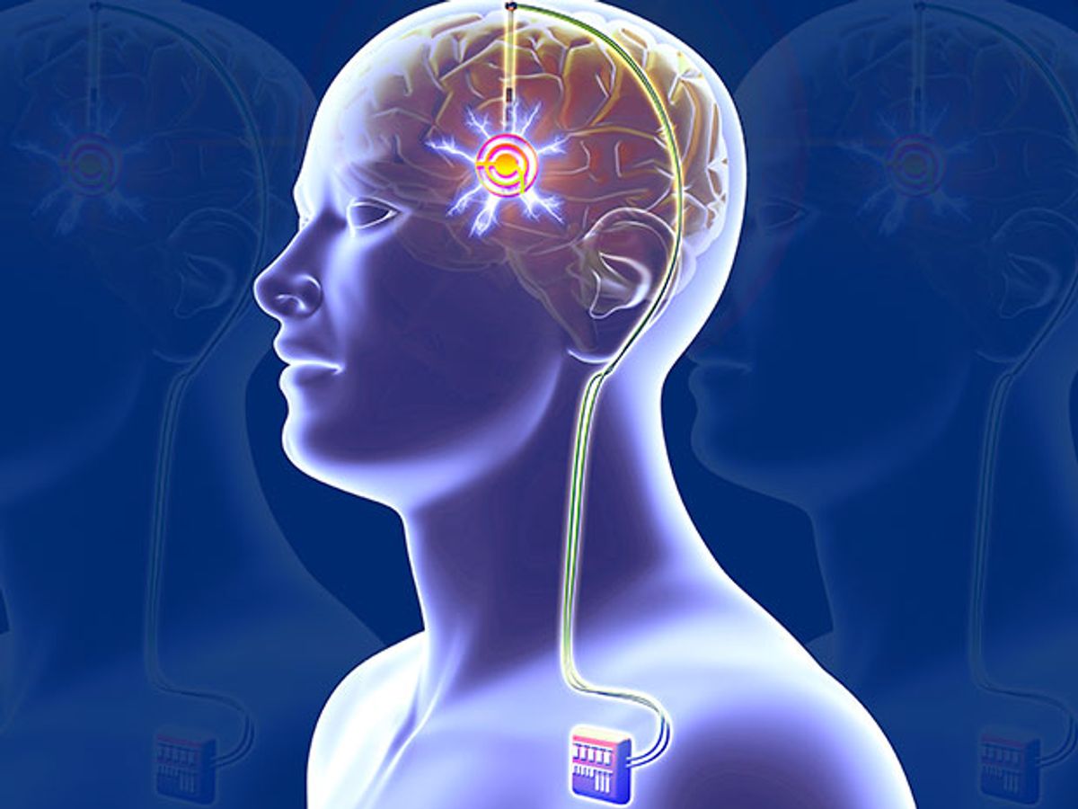 Illustration shows a man's transparent torso with a battery implanted in his shoulder and wires leading to a chip implanted in his brain.