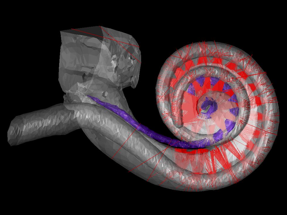 Image of a cochlear implant that uses pulses of electricity to hear