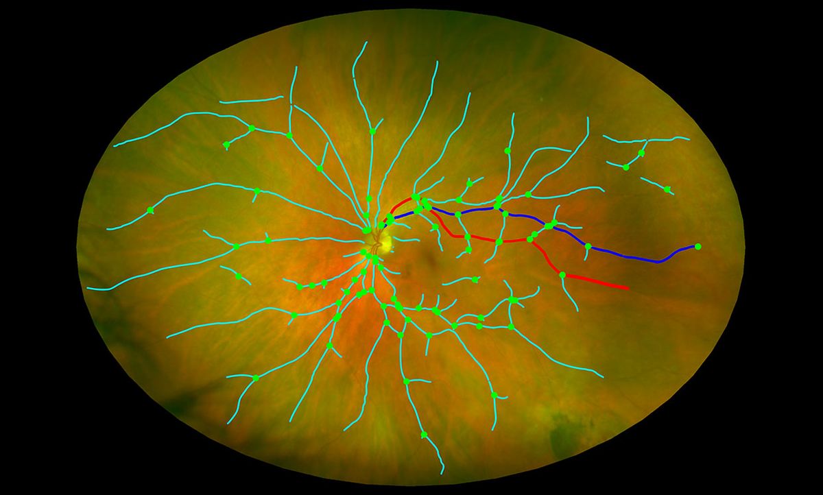 Image of a retina analyzed by the University of Edinburgh eye scan system, which analyzes multiple biomarkers in the eye to detect brain degeneration.