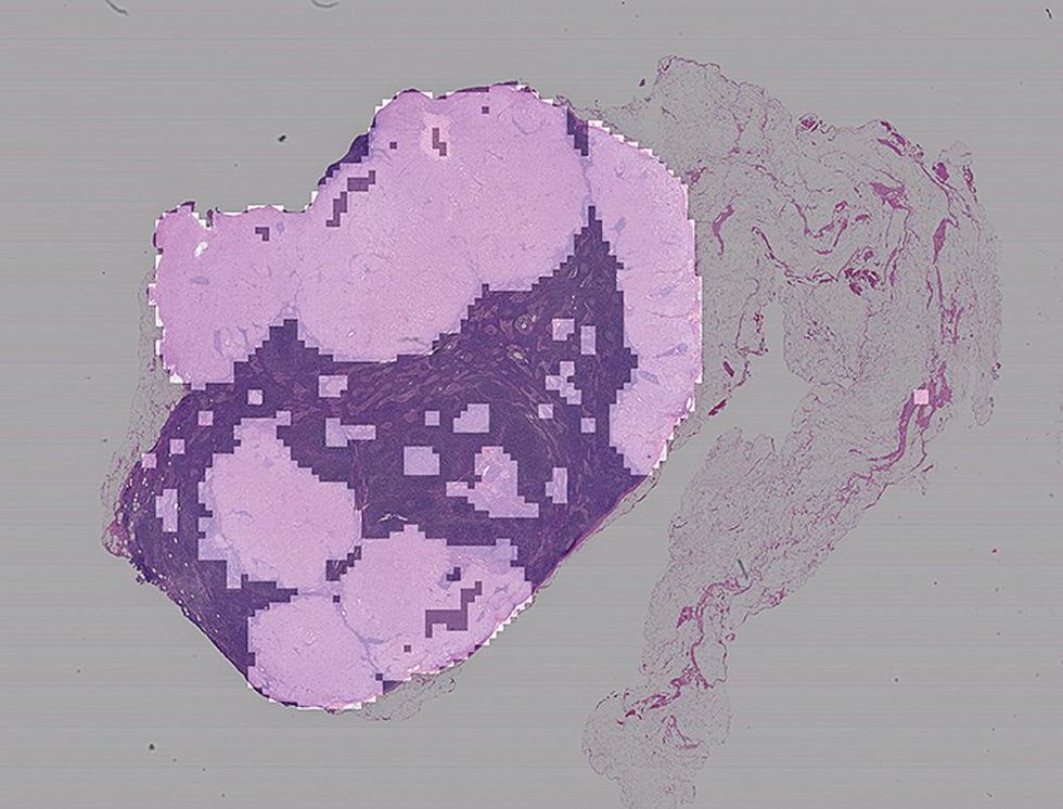 Image of a tumor.