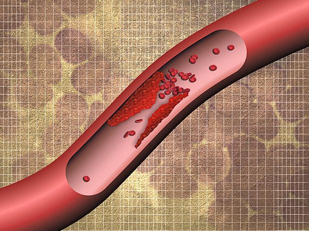Nanoparticle Enables Cheap and Easy Test for Blood Clots - IEEE Spectrum