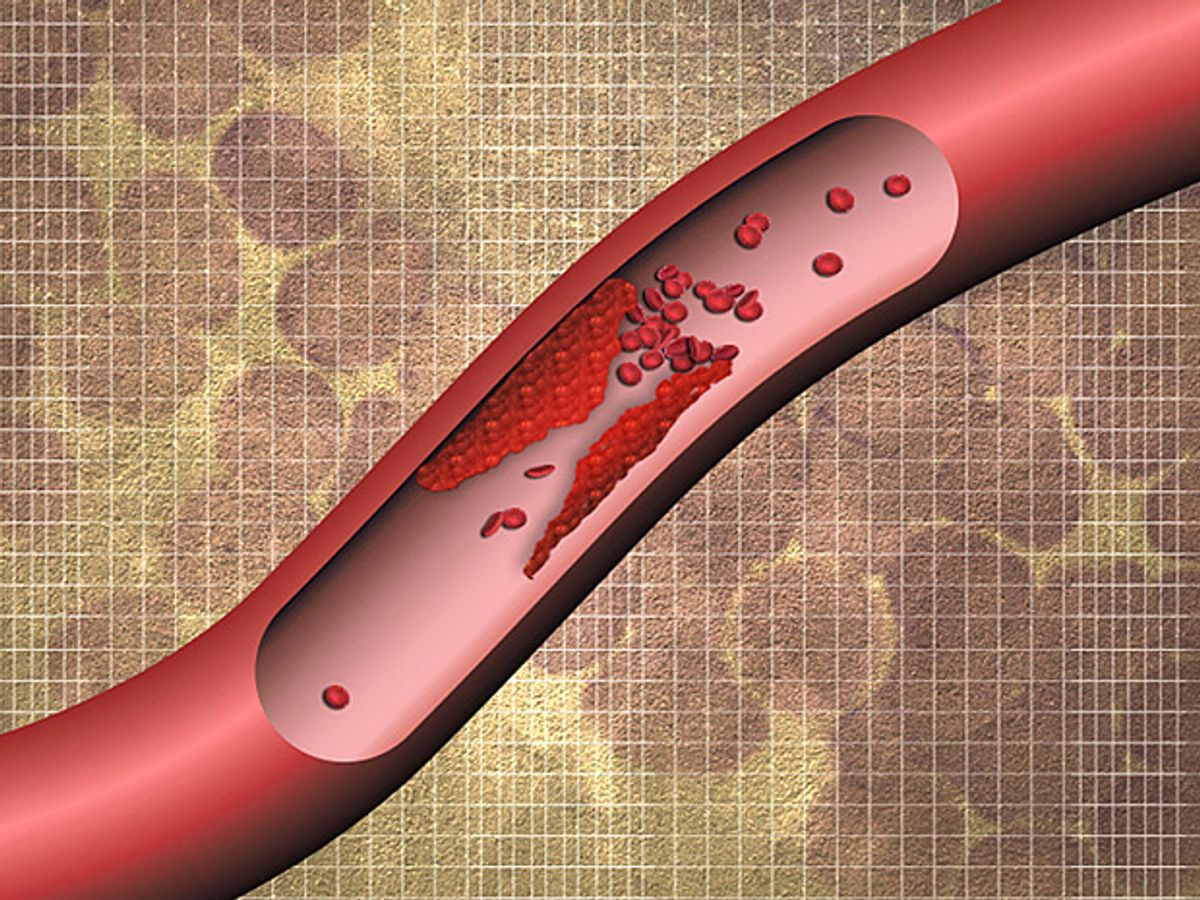Nanoparticle Enables Cheap and Easy Test for Blood Clots
