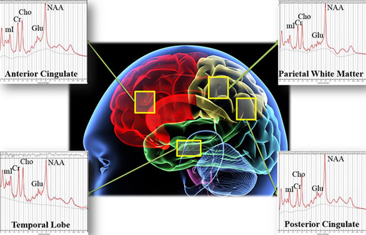 Brain Scans to Distinguish Between Brain Injury and PTSD