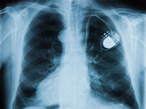 An x-ray image shows an implanted pacemaker
