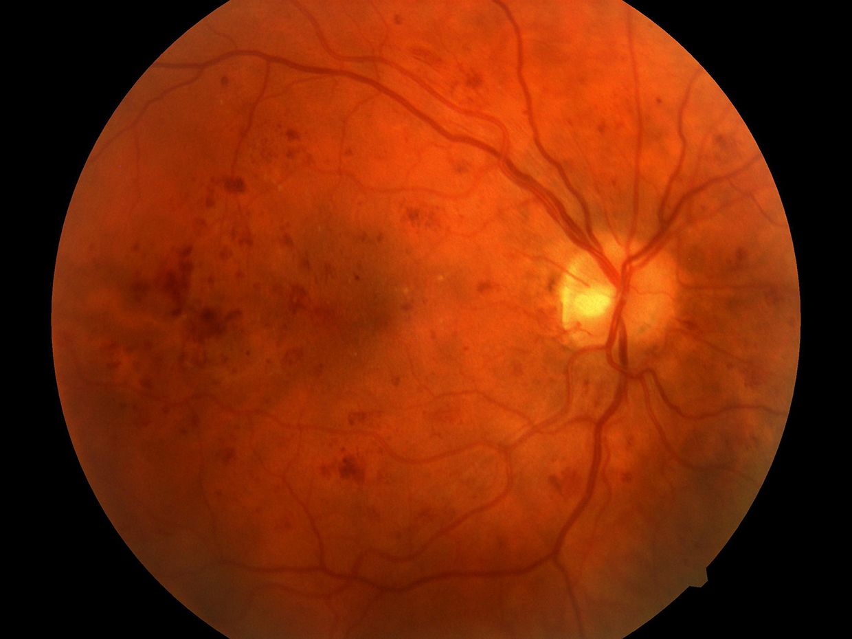 Retinal image showing severe diabetic retinopathy captured by the fundus camera.