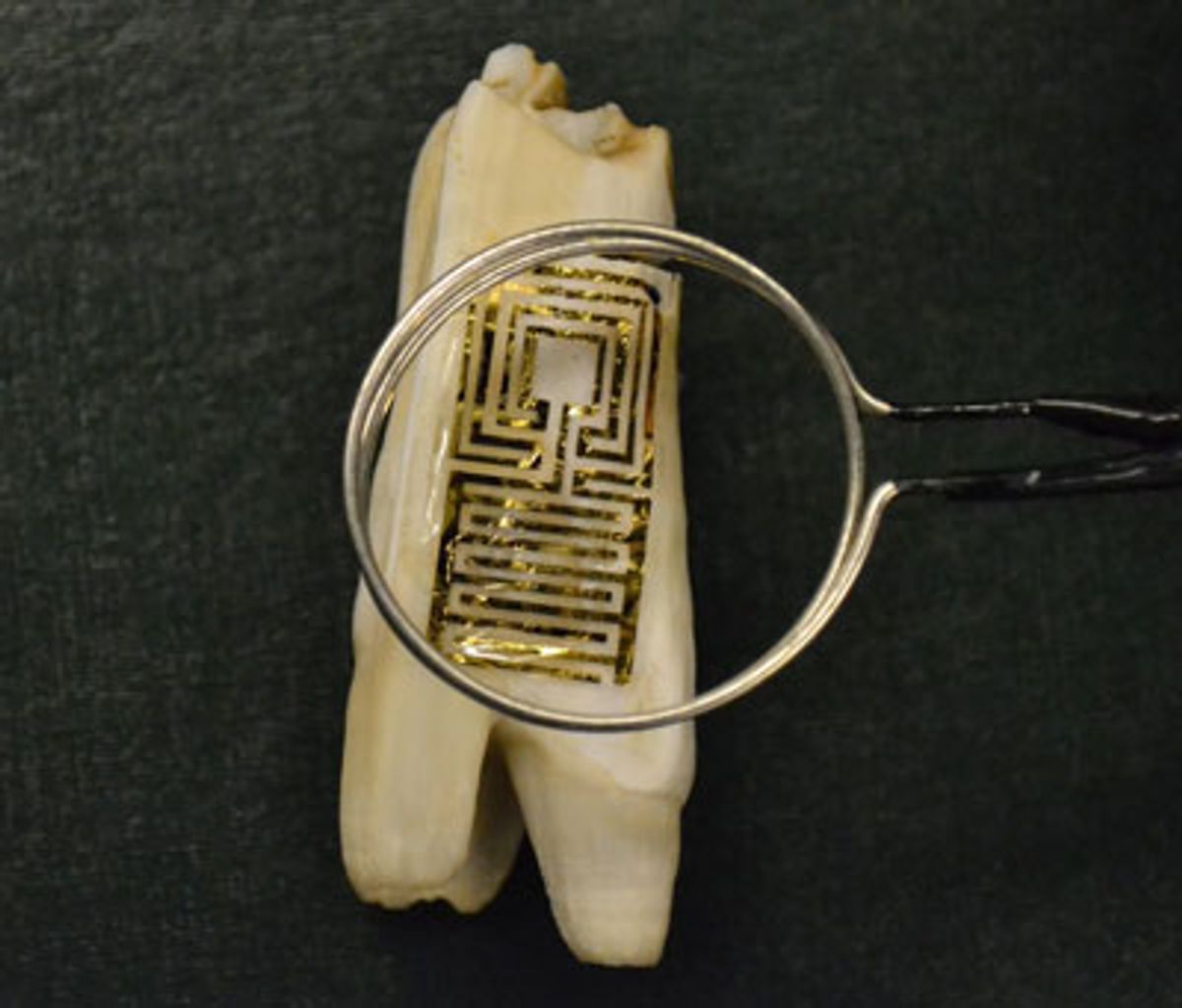 Graphene Nanosensor Tattooed to Teeth Detects Bacteria