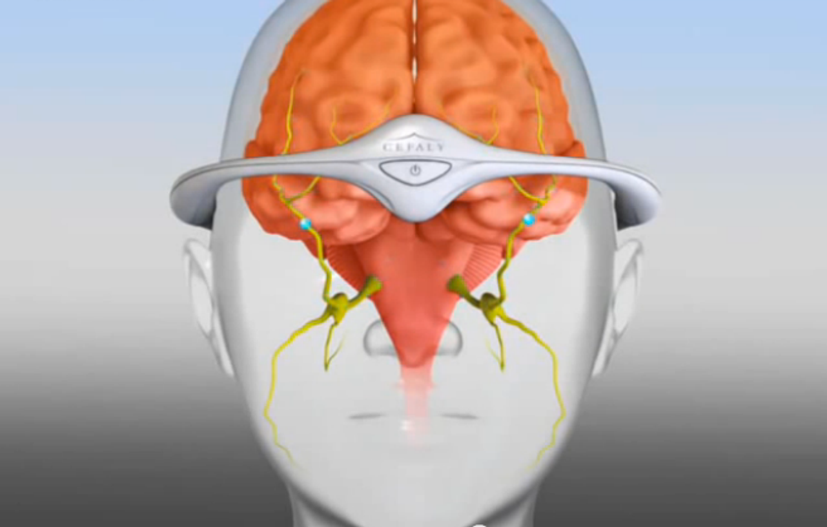 Electrical Stimulator to Prevent Migraines Receives FDA Approval