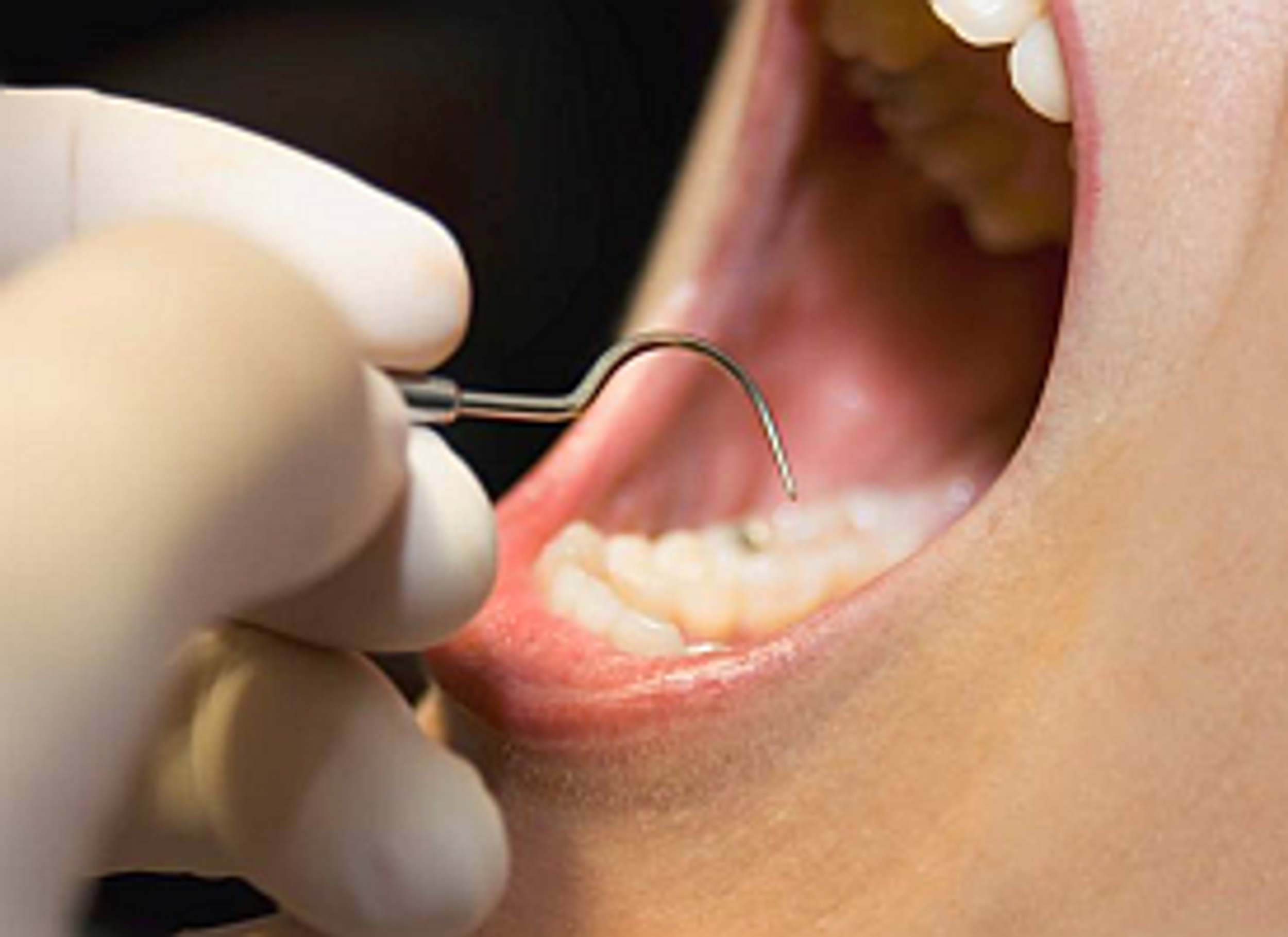 Nanocomposite Fillings Kill Bacteria and Regenerate the Tooth