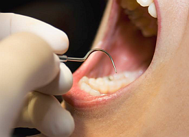 Nanocomposite Fillings Kill Bacteria and Regenerate the Tooth