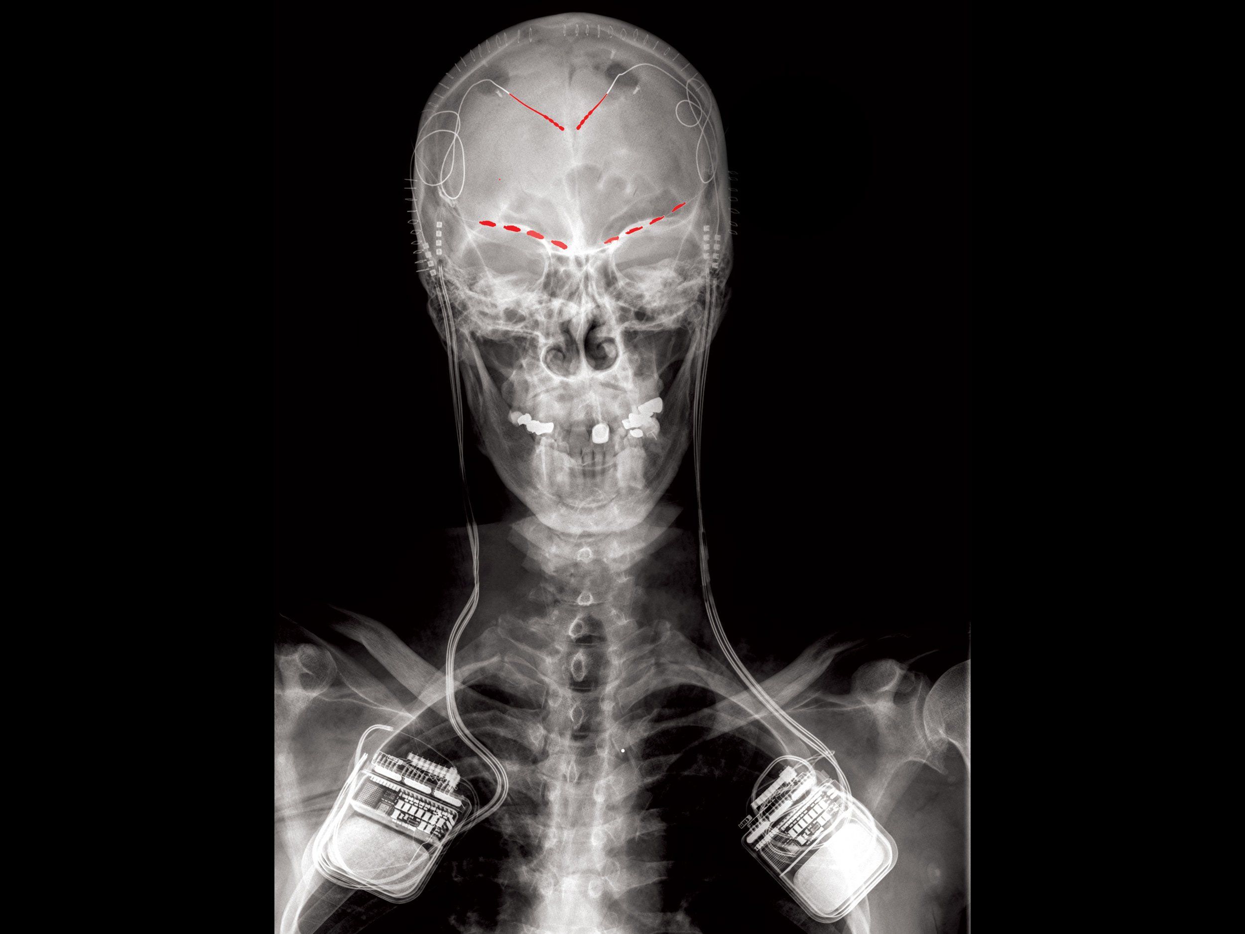 An x-ray of a human skull and shoulders. There are red dotted lines along the eyebrow area and two implants, one in each shoulder.