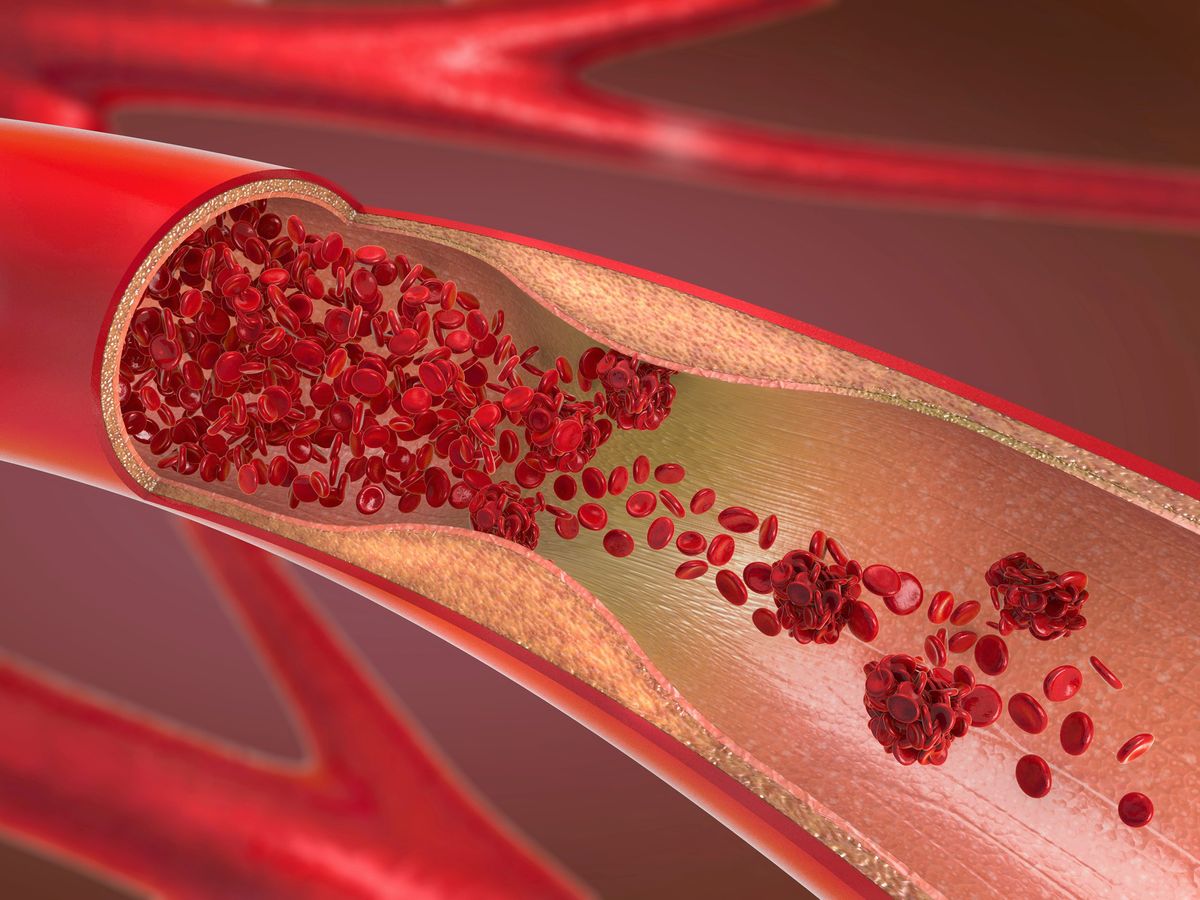 microscopic view of a narrowed blood vessel