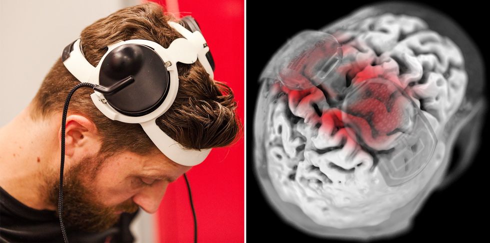 On the left is a photograph of a mans head showing a white and black contraption on his head, on the right is an illustration of the brain showing where the implants are, matching to the headset he wears.