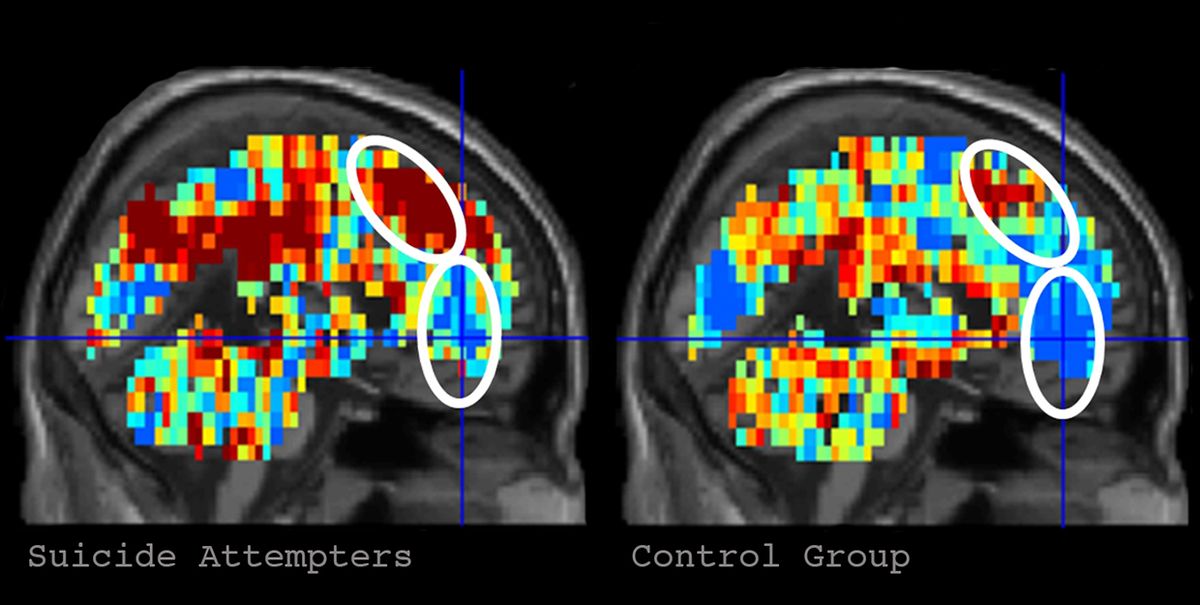 On the left is the brain activation pattern for 'death' in participants who had made a suicide attempt. The image in the right depicts the activation pattern for 'death' in control participants.