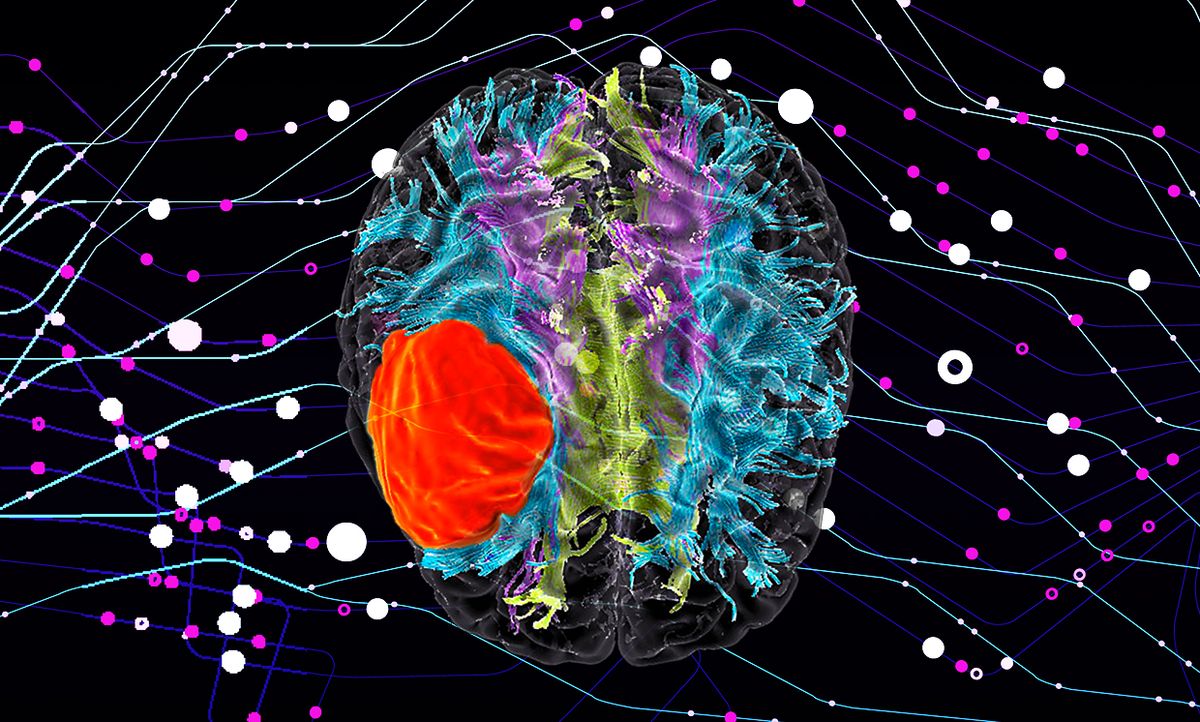 Photo-illustration of a 3D diffusion tensor MRI scan of a patient with glioblastoma brain cancer, over a background of data points.