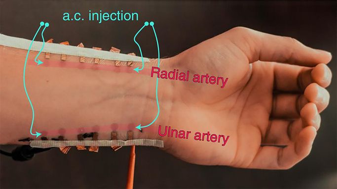 Segments of copper foil are taped to a wrist. The image labels identify the radial and ulnar artery, as well as spots as a.c. injection.