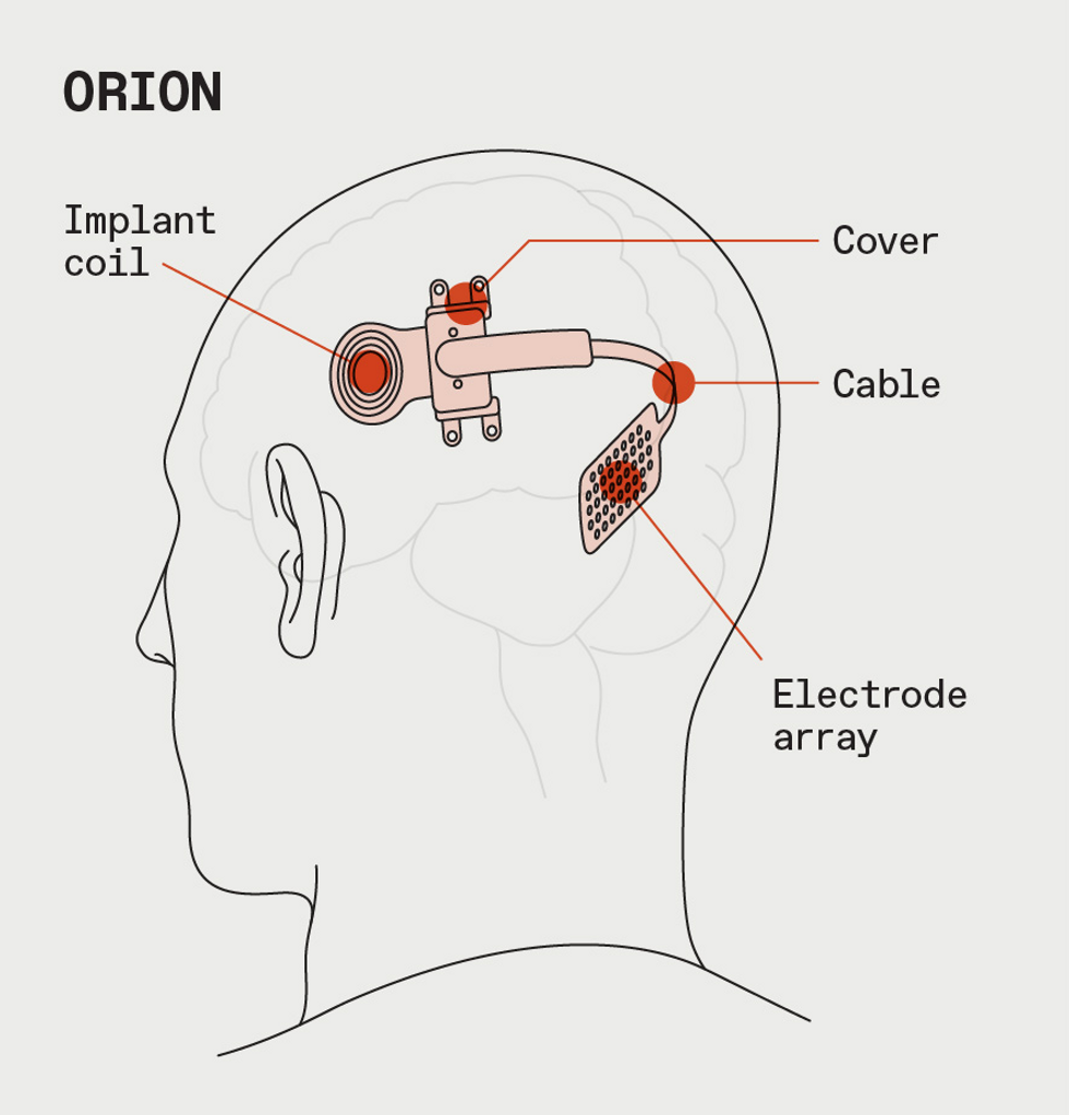 The diagram shows a personu2019s head with the coil and electrode array inside the brain. ge