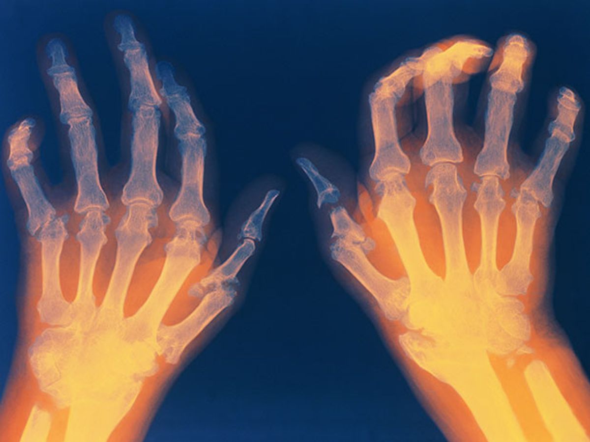 X-ray of the hands of a person suffering from rheumatoid arthritis